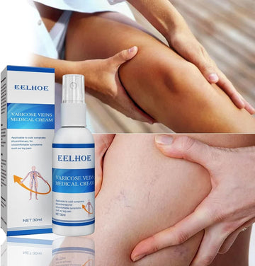 Varicose Vein Cream Spray Varicose Vein Legs and Varicose Vein Swelling